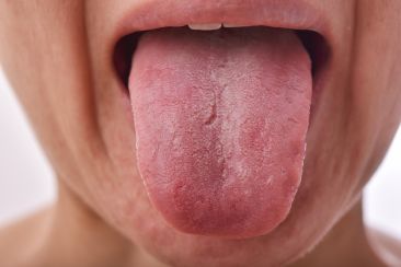 How long does oral thrush last without treatment sales
